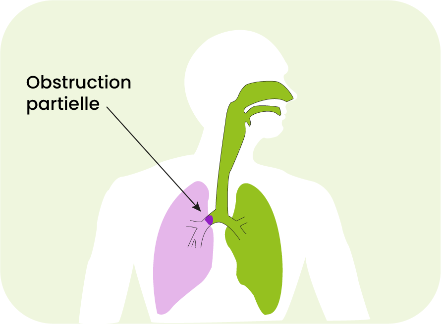 obstruction partielle voies aériennes schéma poumons
