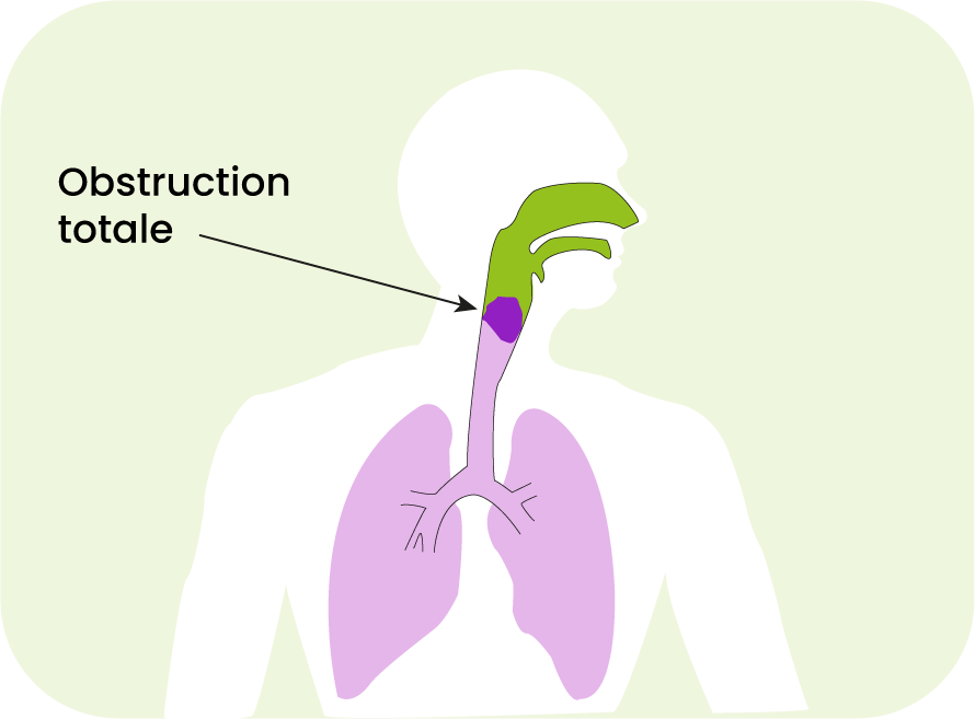 obstruction totale voies aériennes schéma étouffement